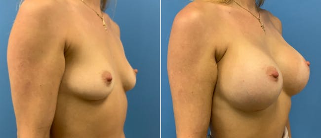 Breast Augmentation Before & After Gallery - Patient 38566337 - Image 1