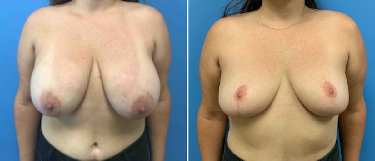 Breast Reduction Before & After Gallery - Patient 38566340 - Image 1