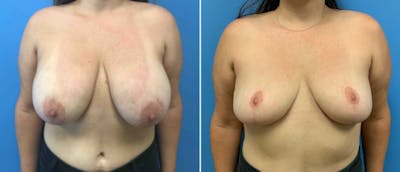 Breast Reduction Before & After Gallery - Patient 38566340 - Image 1