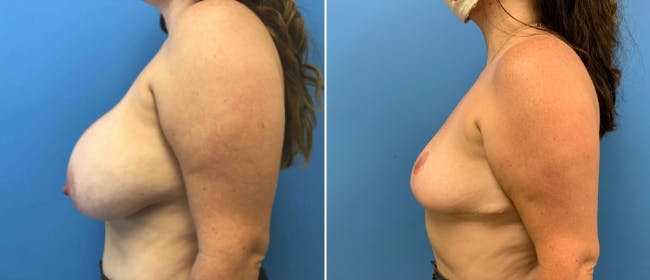 Breast Reduction Before & After Gallery - Patient 38566340 - Image 2
