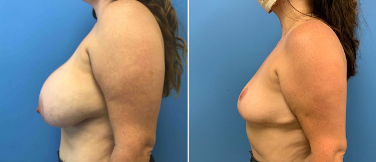 Breast Reduction Before & After Gallery - Patient 38566340 - Image 2