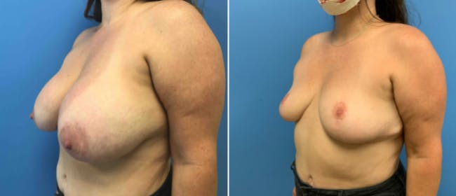 Breast Reduction Before & After Gallery - Patient 38566340 - Image 3
