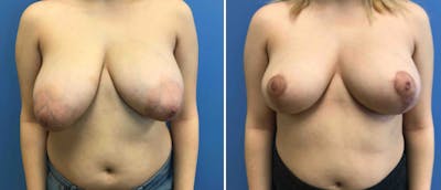 Breast Reduction Before & After Gallery - Patient 38566346 - Image 1