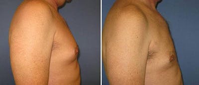 Gynecomastia Before & After Gallery - Patient 414276 - Image 1