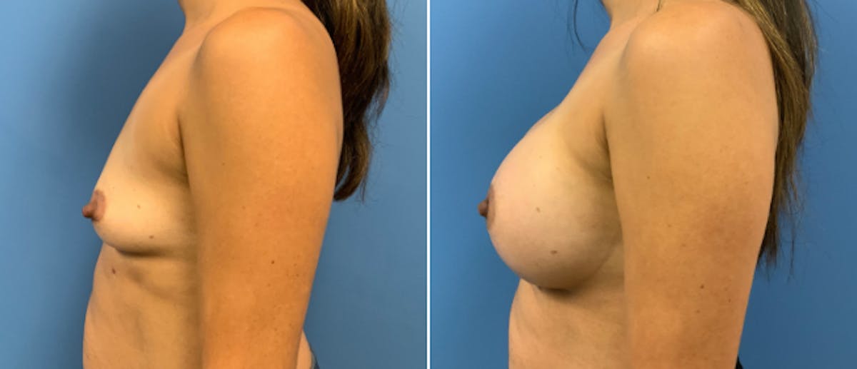 Breast Augmentation Before & After Gallery - Patient 38566350 - Image 2