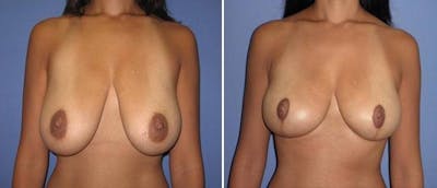 Breast Reduction Before & After Gallery - Patient 38566349 - Image 1