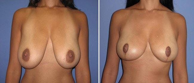 Breast Reduction Before & After Gallery - Patient 38566349 - Image 1