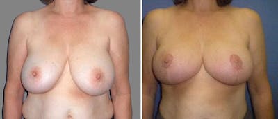 Breast Reduction Before & After Gallery - Patient 38566351 - Image 1