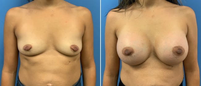 Breast Augmentation Before & After Gallery - Patient 38566350 - Image 1