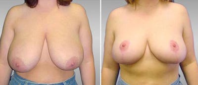 Breast Reduction Before & After Gallery - Patient 38566353 - Image 1