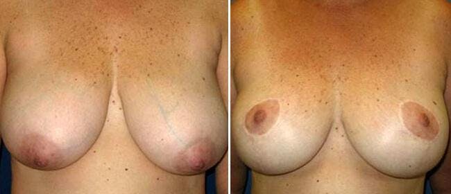 Breast Reduction Before & After Gallery - Patient 38566357 - Image 1