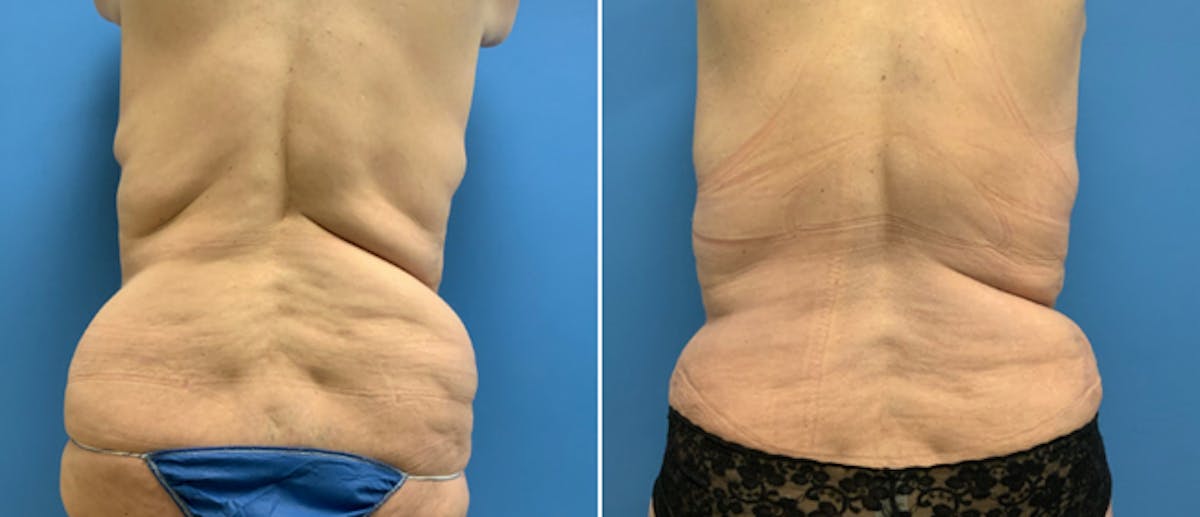 Tummy Tuck Before & After Gallery - Patient 38566359 - Image 2