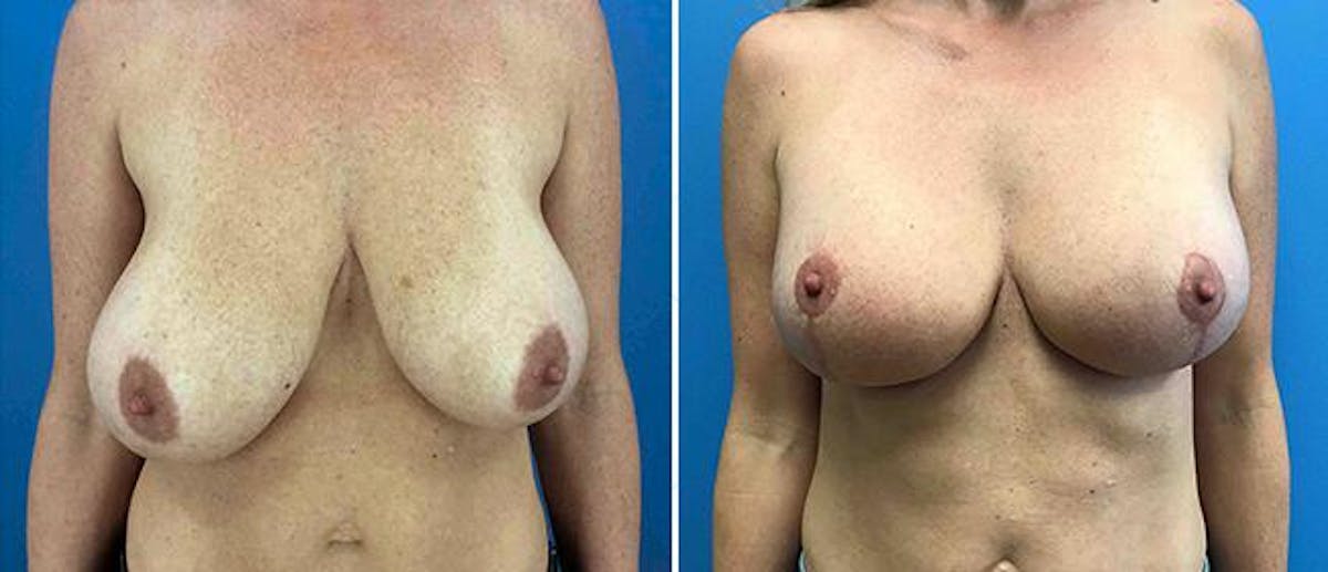 Breast Reduction Before & After Gallery - Patient 38566358 - Image 1