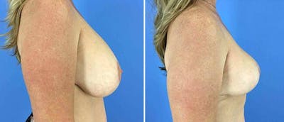 Breast Reduction Before & After Gallery - Patient 38566361 - Image 1