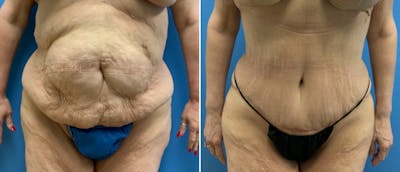 Tummy Tuck Before & After Gallery - Patient 38566359 - Image 1