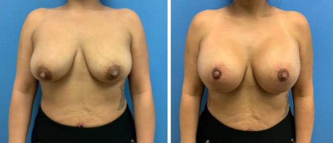Breast Augmentation Before & After Gallery - Patient 38566354 - Image 1
