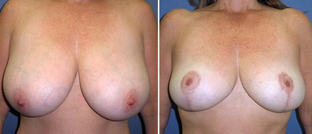 Breast Reduction Before & After Gallery - Patient 38566365 - Image 1