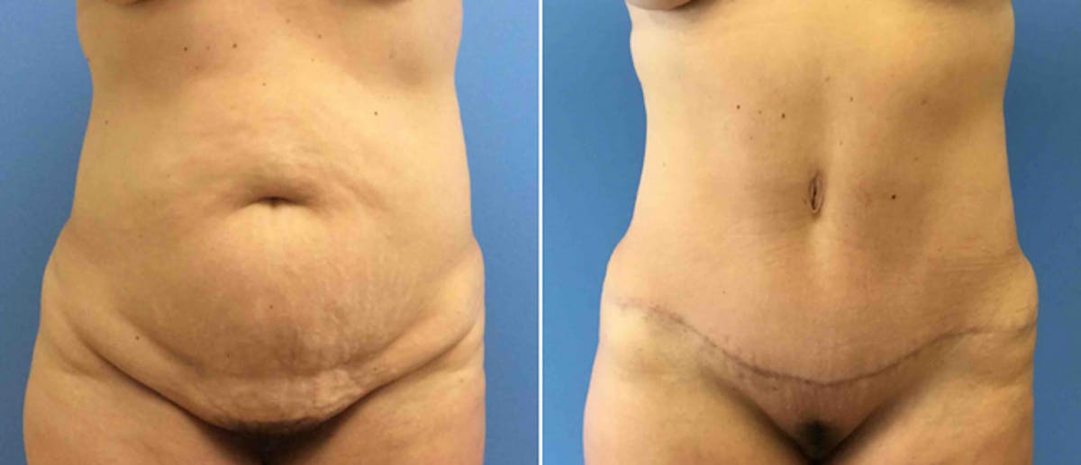 Tummy Tuck Before & After Gallery - Patient 38566368 - Image 1