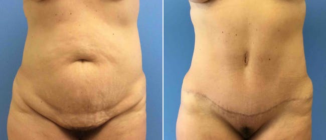Abdominoplasty (Tummy Tuck) Before & After Gallery - Patient 38566368 - Image 1