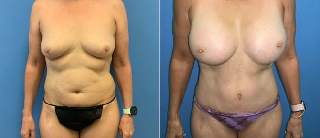Breast Augmentation Before & After Gallery - Patient 38566369 - Image 1