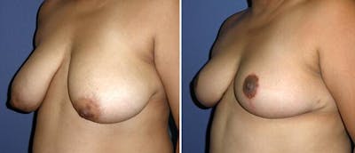 Breast Reduction Before & After Gallery - Patient 38566367 - Image 1