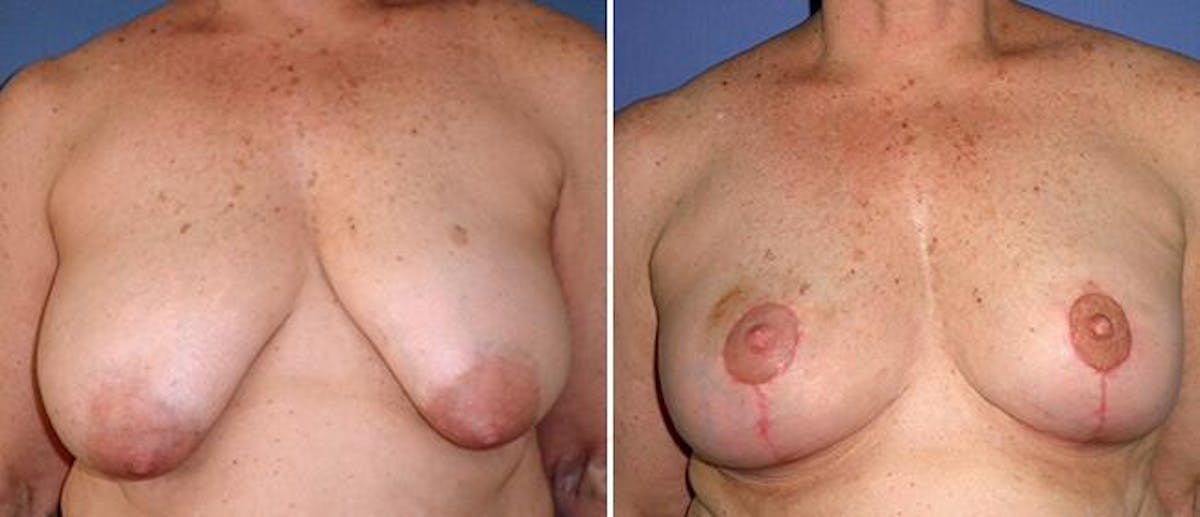 Breast Reduction Before & After Gallery - Patient 38566370 - Image 1