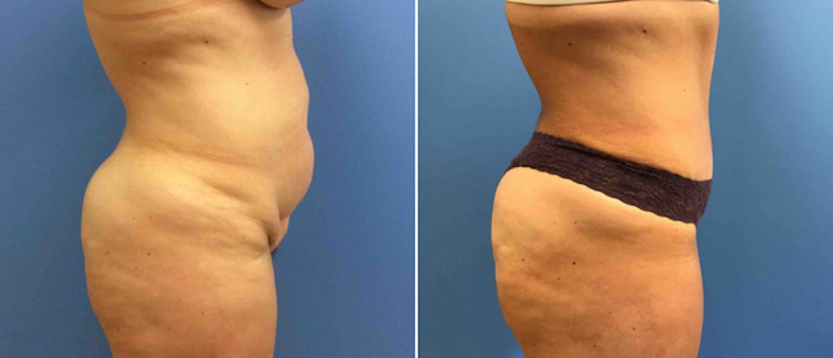 Tummy Tuck Before & After Gallery - Patient 38566368 - Image 2