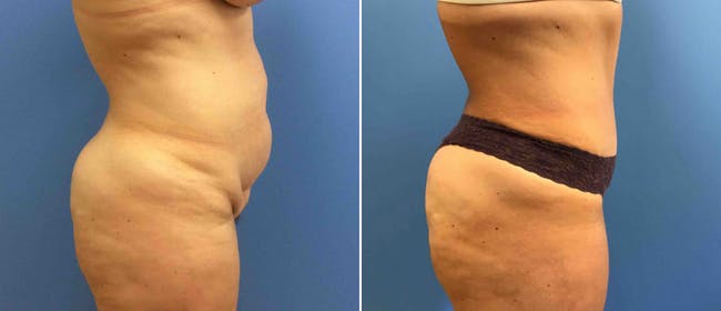 Abdominoplasty (Tummy Tuck) Before & After Gallery - Patient 38566368 - Image 2