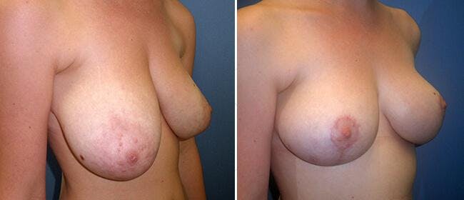 Breast Reduction Before & After Gallery - Patient 38566373 - Image 1