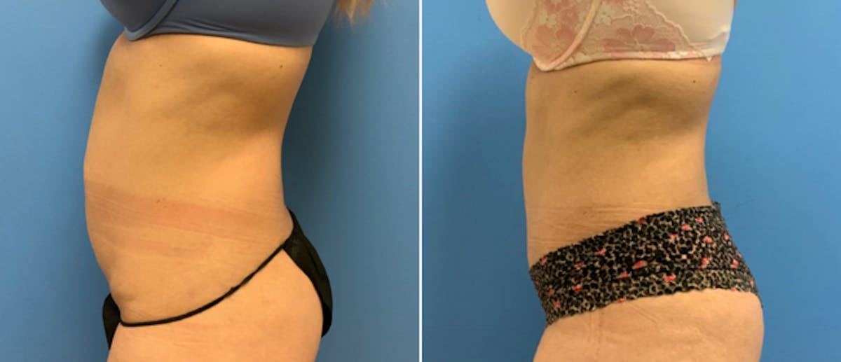Tummy Tuck Before & After Gallery - Patient 38566375 - Image 2