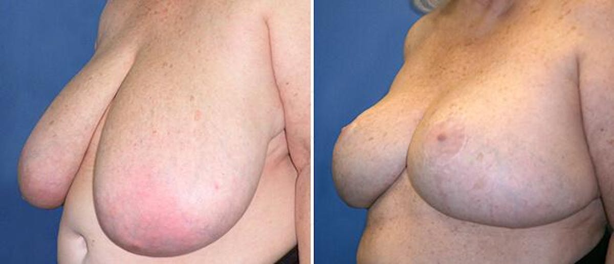 Breast Reduction Before & After Gallery - Patient 38566376 - Image 1