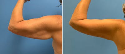 Arm Lift Before & After Gallery - Patient 38566377 - Image 1