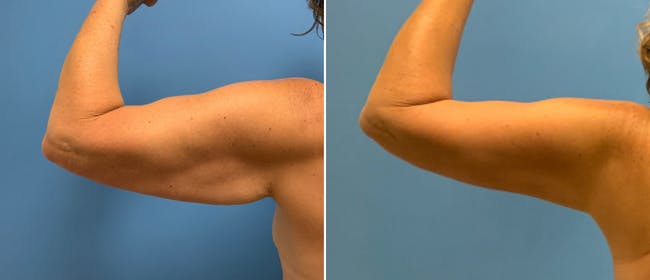 Brachioplasty (Upper Arm Lift) Before & After Gallery - Patient 38566377 - Image 1