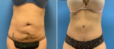 Tummy Tuck Before & After Gallery - Patient 38566375 - Image 1