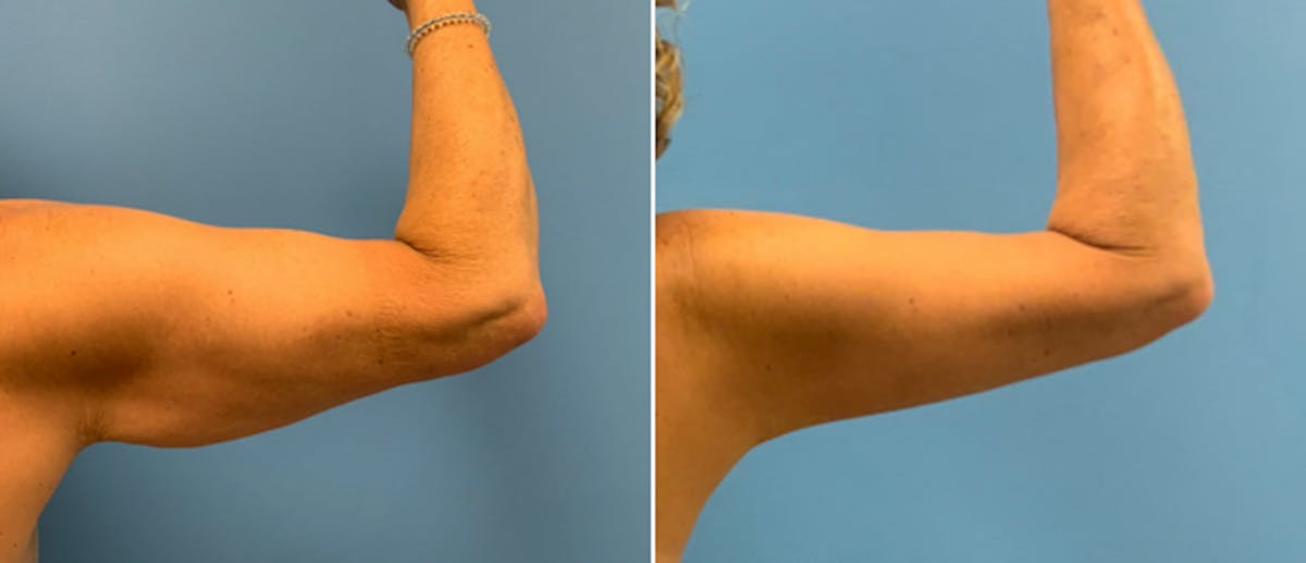 Brachioplasty (Upper Arm Lift) Before & After Gallery - Patient 38566377 - Image 2