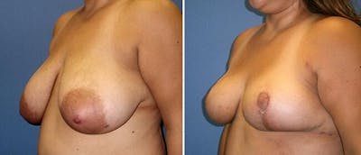 Breast Reduction Before & After Gallery - Patient 38566382 - Image 1
