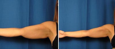 Arm Lift Before & After Gallery - Patient 38566387 - Image 1