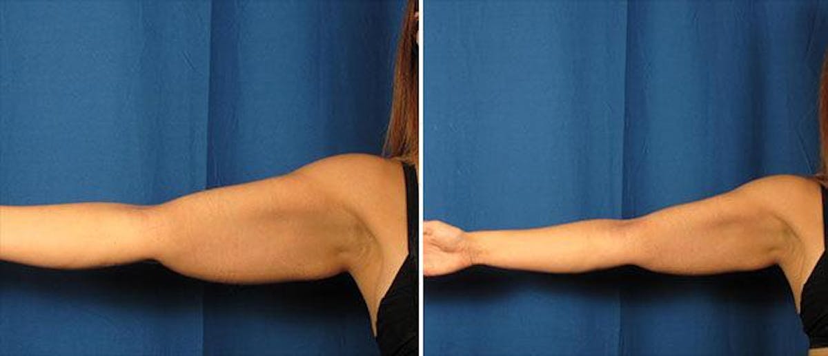 Brachioplasty (Upper Arm Lift) Before & After Gallery - Patient 38566387 - Image 1