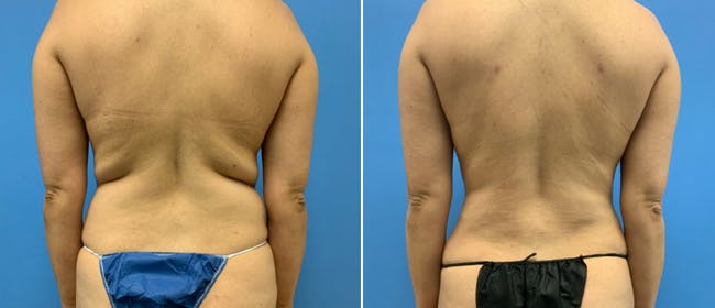 Abdominoplasty (Tummy Tuck) Before & After Gallery - Patient 38566384 - Image 3
