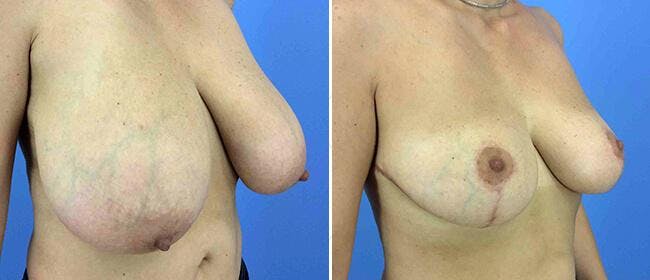 Breast Reduction Before & After Gallery - Patient 38566389 - Image 1