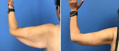 Brachioplasty (Upper Arm Lift) Before & After Gallery - Patient 38566391 - Image 1