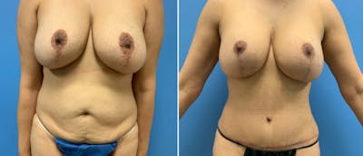 Abdominoplasty (Tummy Tuck) Before & After Gallery - Patient 38566384 - Image 1