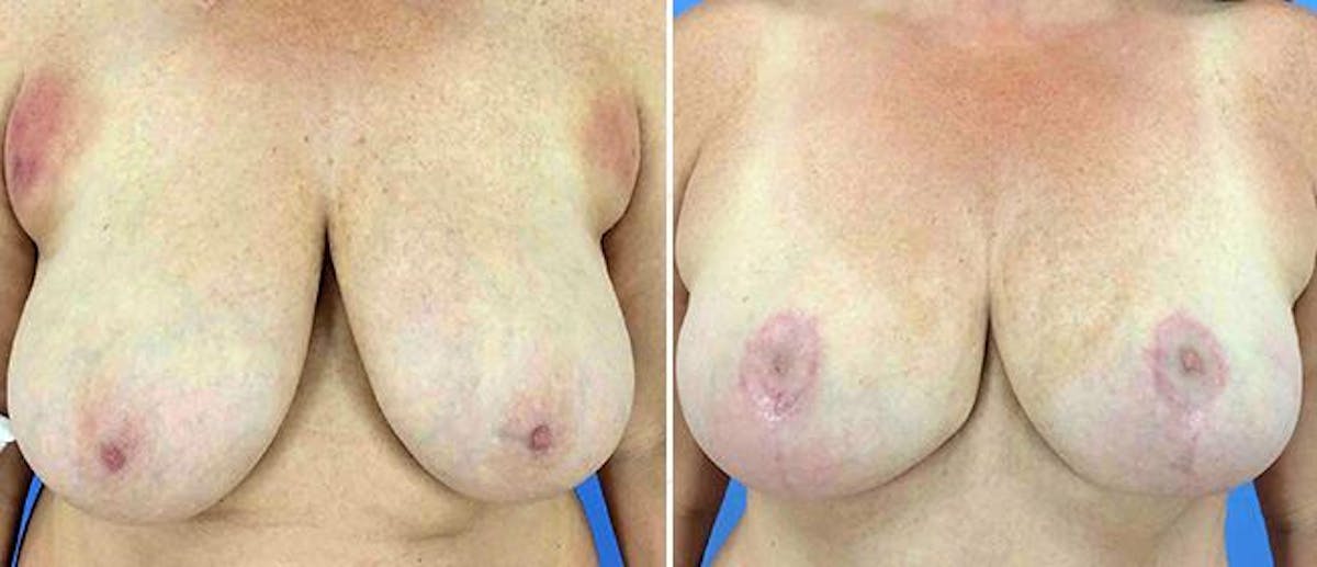 Breast Reduction Before & After Gallery - Patient 38566393 - Image 1