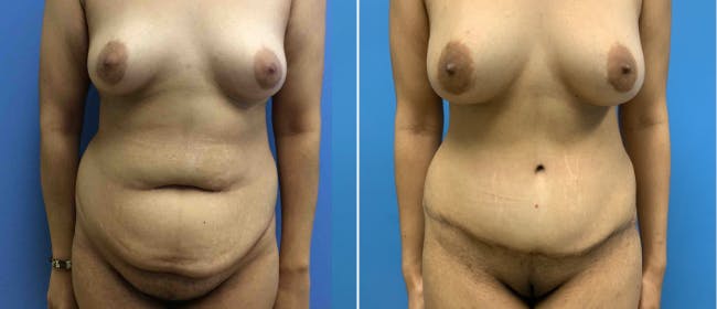 Breast Augmentation Before & After Gallery - Patient 38566394 - Image 1