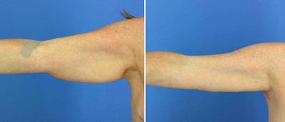 Brachioplasty (Upper Arm Lift) Before & After Gallery - Patient 38566395 - Image 1