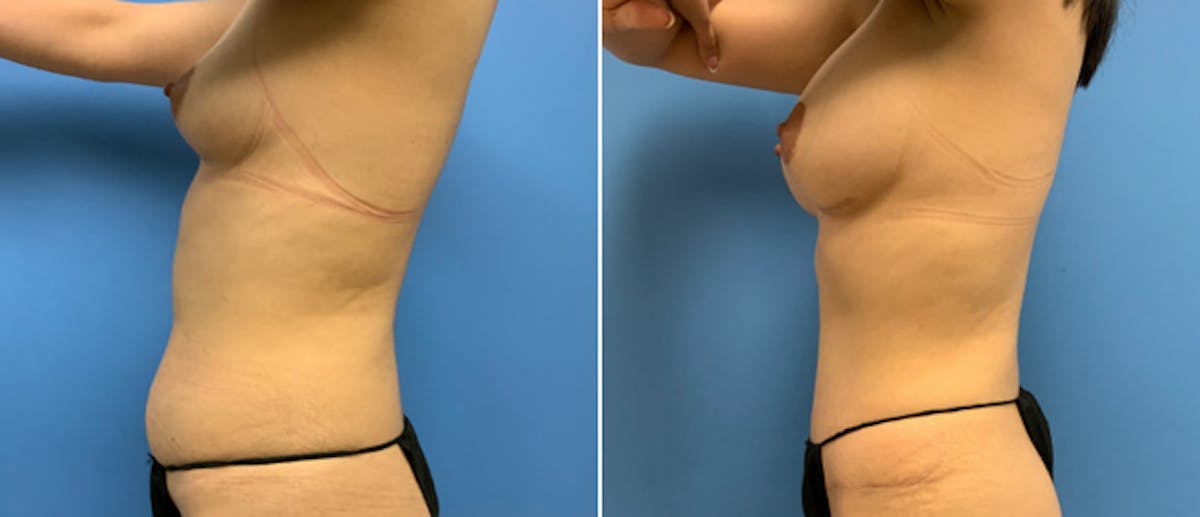 Mommy Makeover Before & After Gallery - Patient 41697363 - Image 2