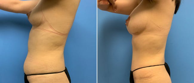 Abdominoplasty (Tummy Tuck) Before & After Gallery - Patient 38566397 - Image 2