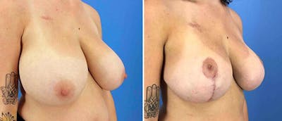 Breast Reduction Before & After Gallery - Patient 38566396 - Image 1
