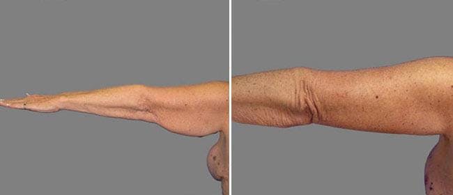 Brachioplasty (Upper Arm Lift) Before & After Gallery - Patient 38566398 - Image 1