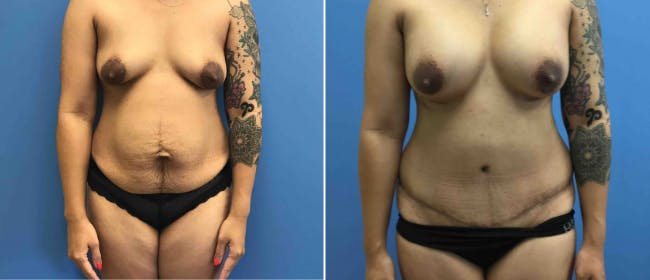 Breast Augmentation Before & After Gallery - Patient 38566400 - Image 1